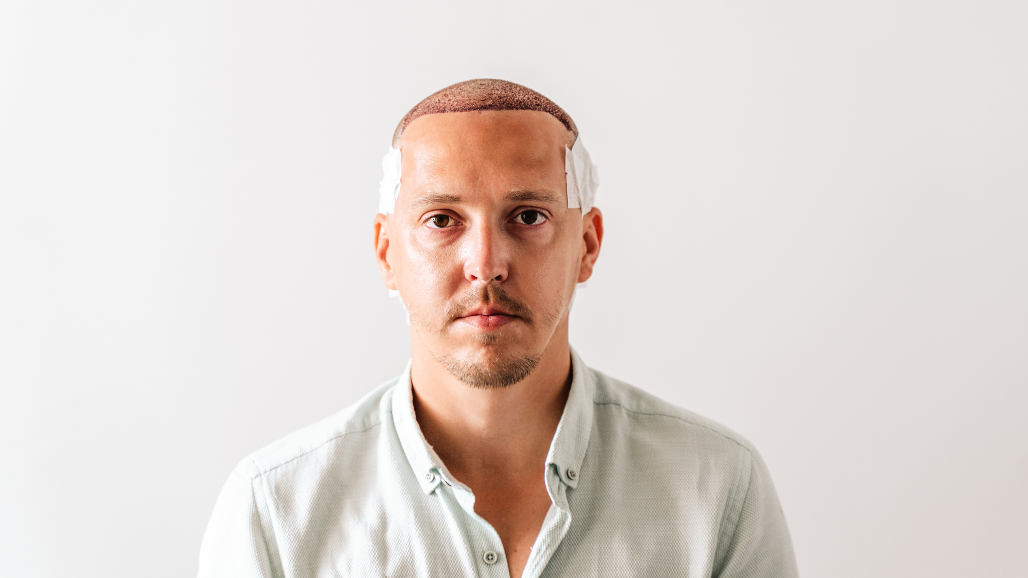 Schwellungen nach der Haartransplantation – Ursachen, Tipps & Heilungsverlauf